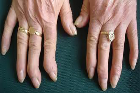artrosis-de-manos